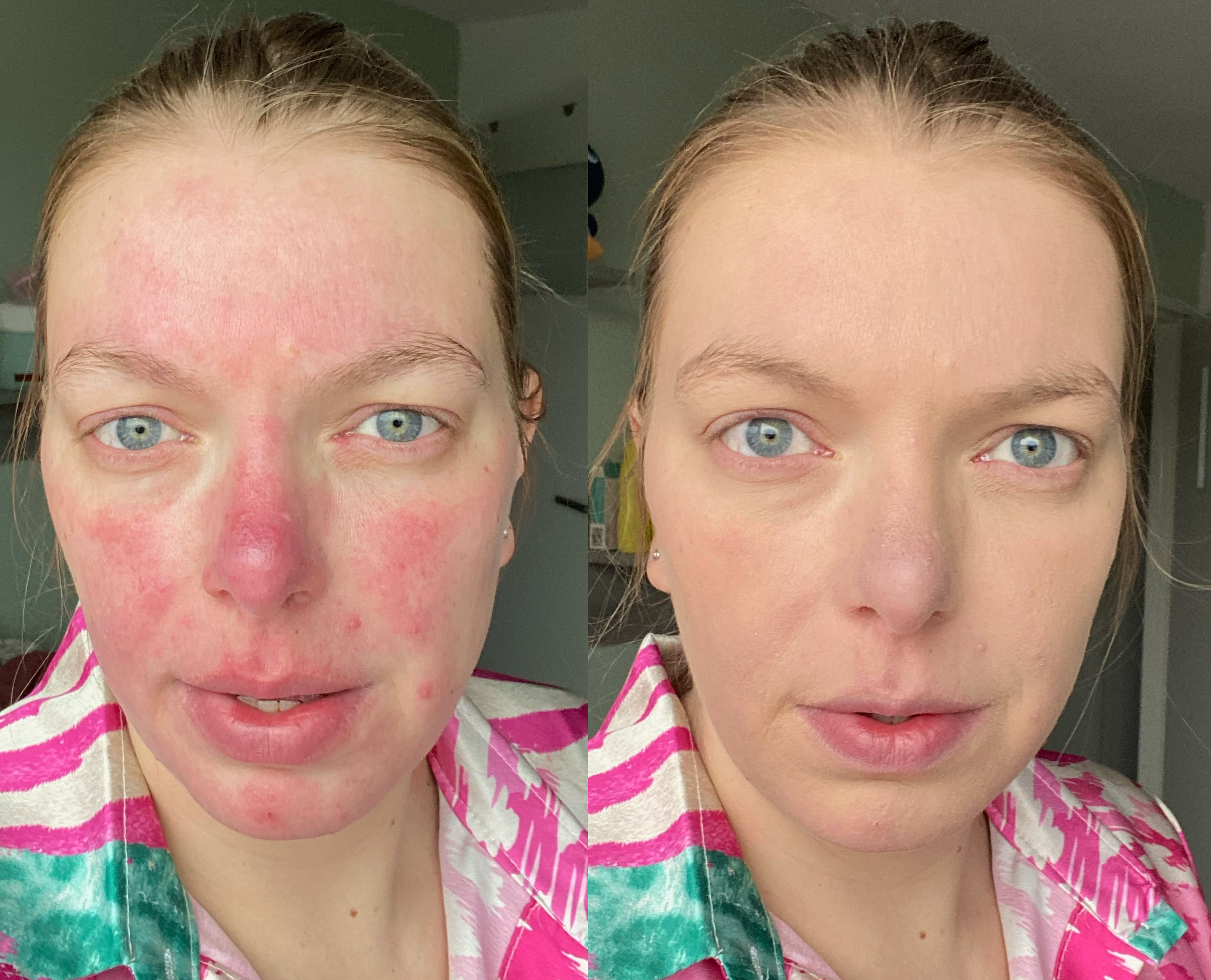 Roodheid zoals rosacea en couperose camoufleren met minerale makeup